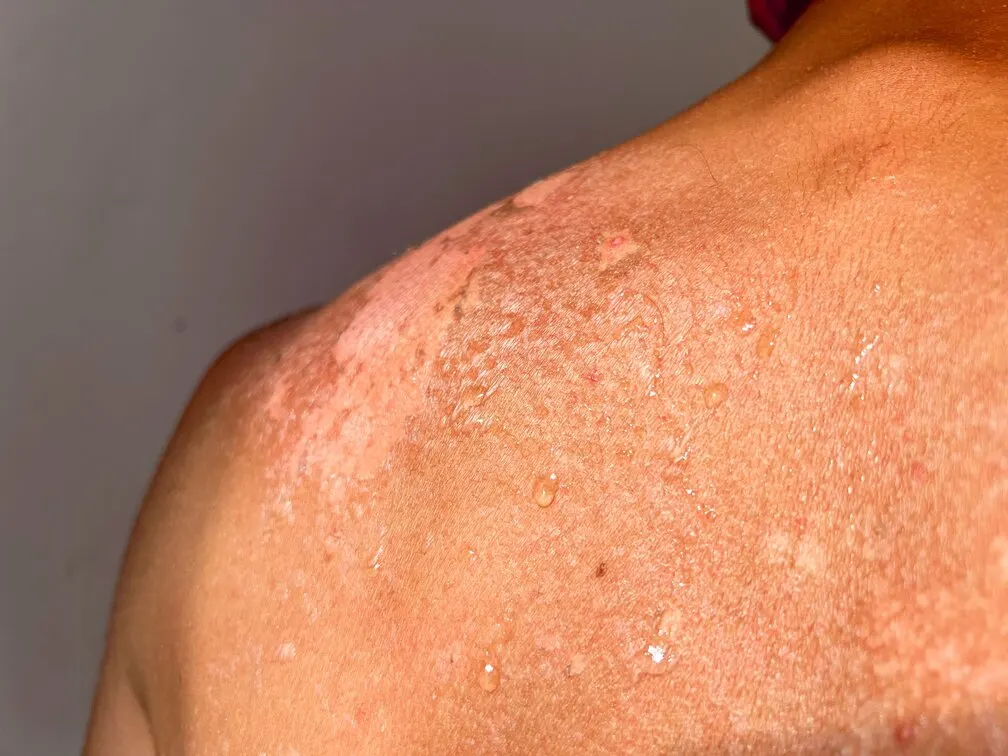 Psoriasis