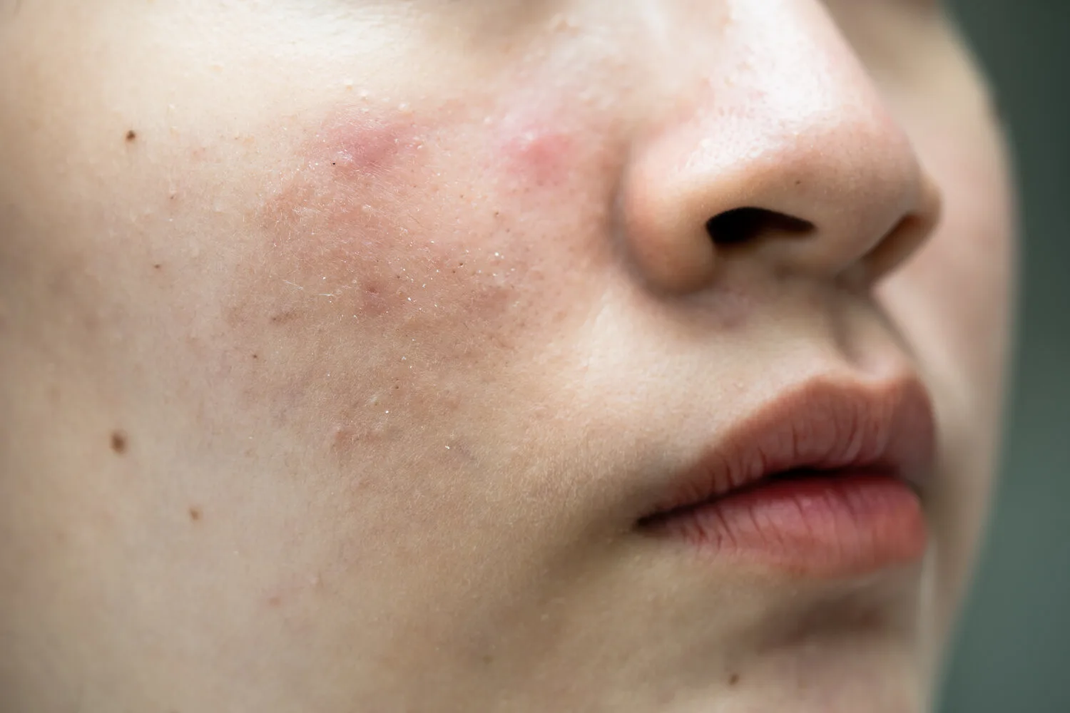 Rosacea